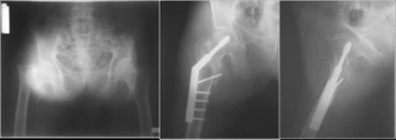 Pelvis Kırığı Ameliyatı Riskleri ve Sonrası